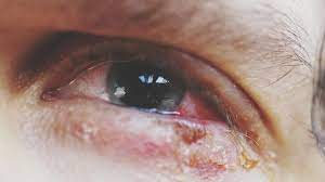 Caution: This disease can occur if water is constantly dripping from the eyes