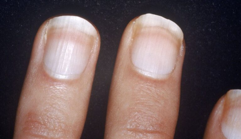 Don't overlook the change in nail color by mistake: this may be the disease