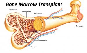 Talk of relief! Stem cell treatment at SSG Hospital in Vadodara will now cost only Rs 25,000