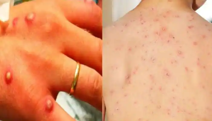 Monkey Pox after Corona? A five-year-old girl in Ghaziabad showed symptoms of monkey pox; Sample sent to Pune