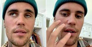 hollywood-singer-justin-bieber-is-suffering-from-ramsay-hunt-syndrome
