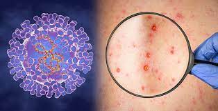 Monkey Pox after Corona? A five-year-old girl in Ghaziabad showed symptoms of monkey pox; Sample sent to Pune