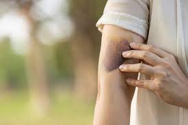 If the platelets in the body are very important! If platelets are low, consume this item