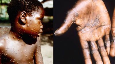 WHO issues red alert for monkeypox in 29 countries Suggestion that these countries should take special care