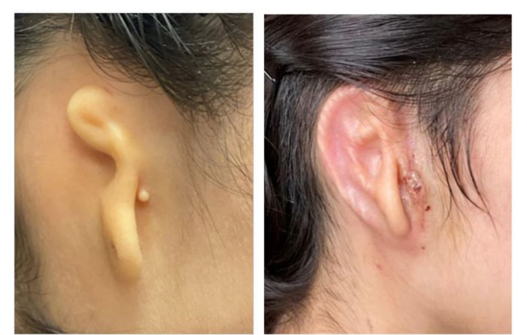 The doctors did a wonderful job! Gave the young lady a new ear using 3D printing technology