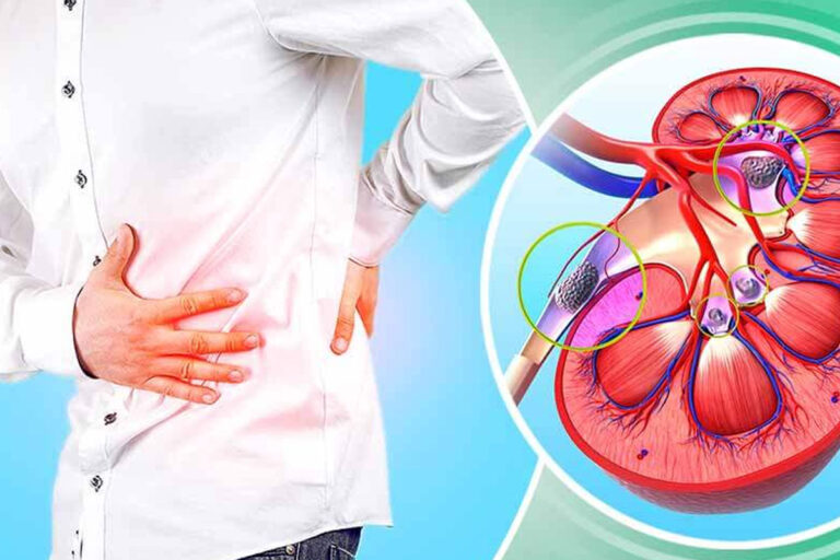 take-special-care-to-avoid-kidney-stones-and-infections