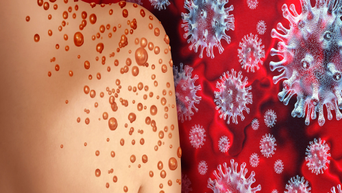 another-case-of-monkeypox-was-reported-in-kerala