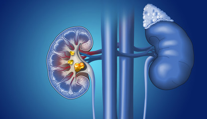 take-special-care-to-avoid-kidney-stones-and-infections