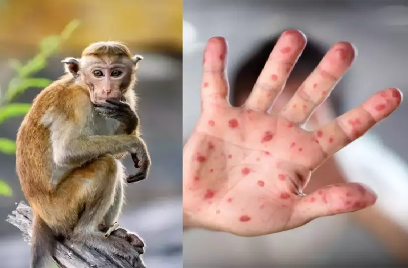 ministry-of-health-announces-guideline-on-monkeypox-virus-know-what-said