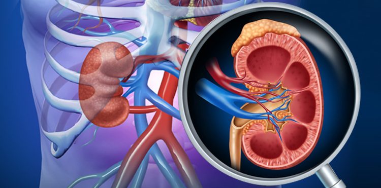 take-special-care-to-avoid-kidney-stones-and-infections