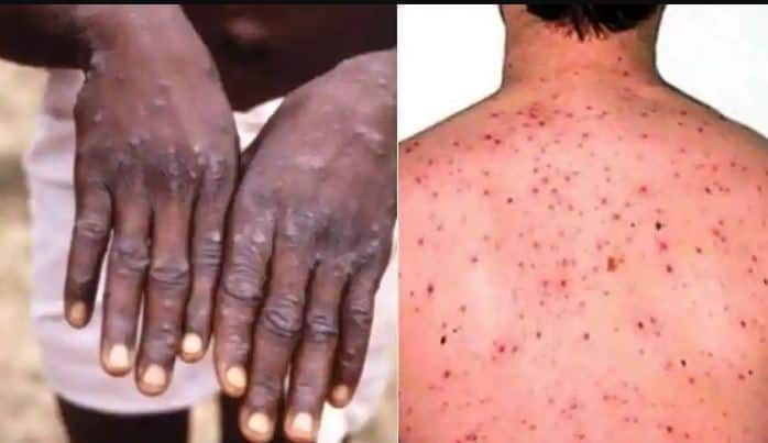 A big revelation came in the research about monkeypox! New symptoms appeared