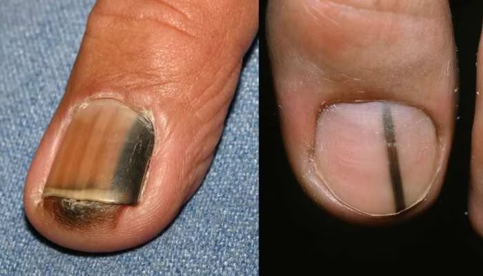 are-black-and-white-spots-on-nails-auspicious-or-inauspicious-its-great-secret-is-revealed-in-samudrashastra