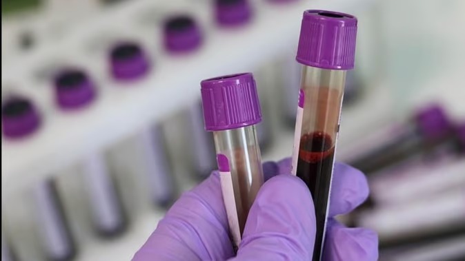 Not only anxiety-stress, iron deficiency can also cause depression, women are at higher risk.