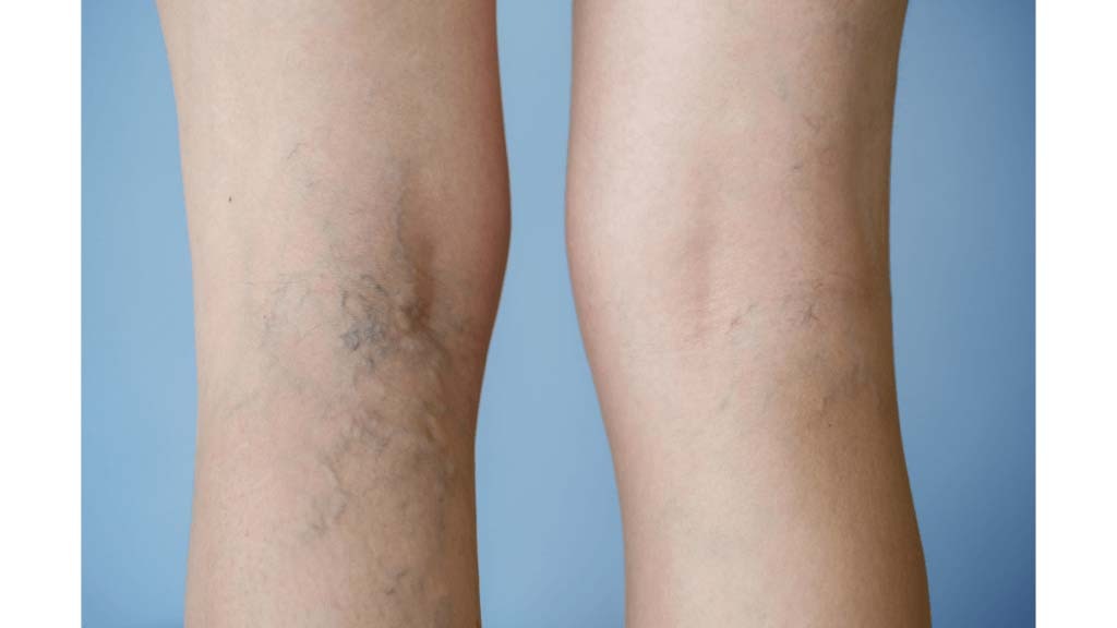 Eat this green vegetable in the problem of varicose veins, the symptoms will improve quickly