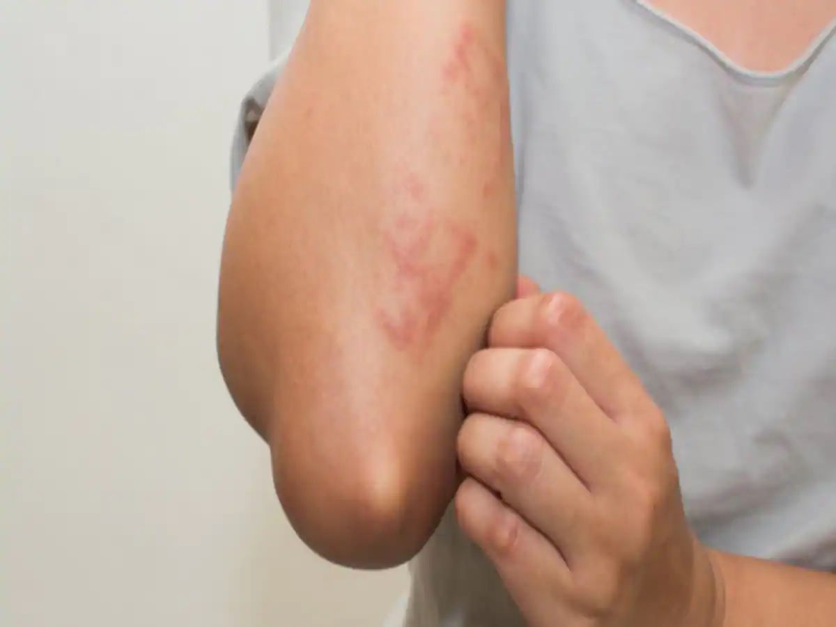 Scabies is a dangerous infection that spreads from one person to another, not only adults but also children can fall victim to it.
