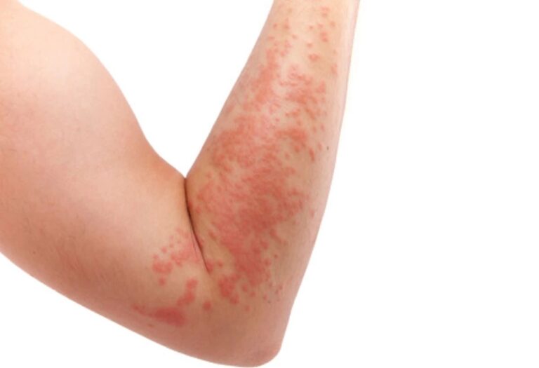 Scabies is a dangerous infection that spreads from one person to another, not only adults but also children can fall victim to it.