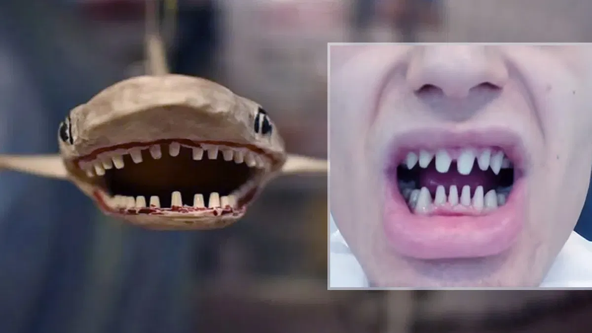 man-spends-3-lakhs-on-fake-teeth-now-looks-like-a-shark