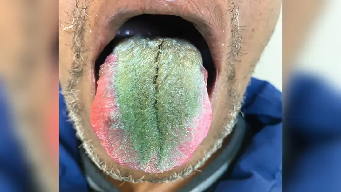 After taking antibiotics, the tongue turned green, black hair started growing, even the doctor started thinking